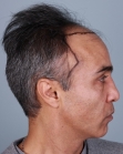 Before Hair Transplant&nbsp;Front